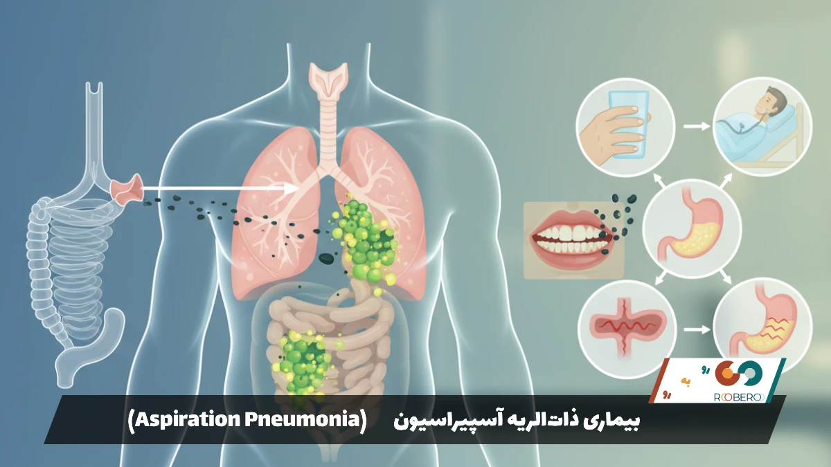 بیماری ذات‌الریه آسپیراسیون (Aspiration Pneumonia)