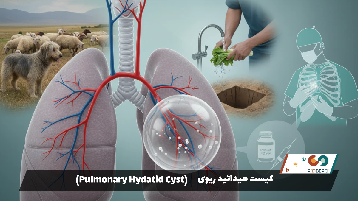 بیماری کیست هیداتید ریوی (Pulmonary Hydatid Cyst)