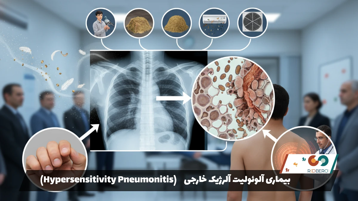بیماری آلوئولیت آلرژیک خارجی (Hypersensitivity Pneumonitis)