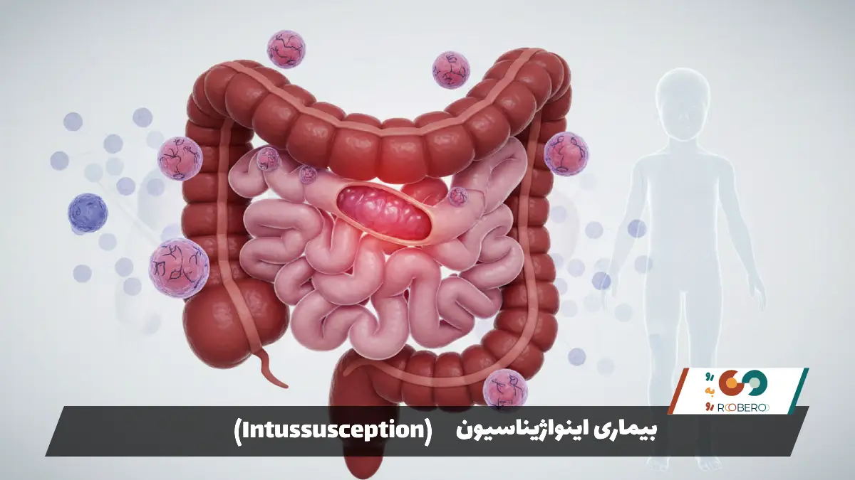 بیماری اینواژیناسیون (Intussusception)