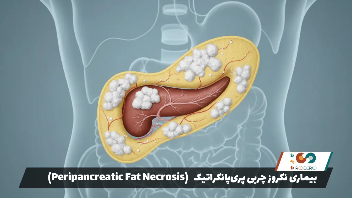 بیماری نکروز چربی پری‌پانکراتیک (Peripancreatic Fat Necrosis)