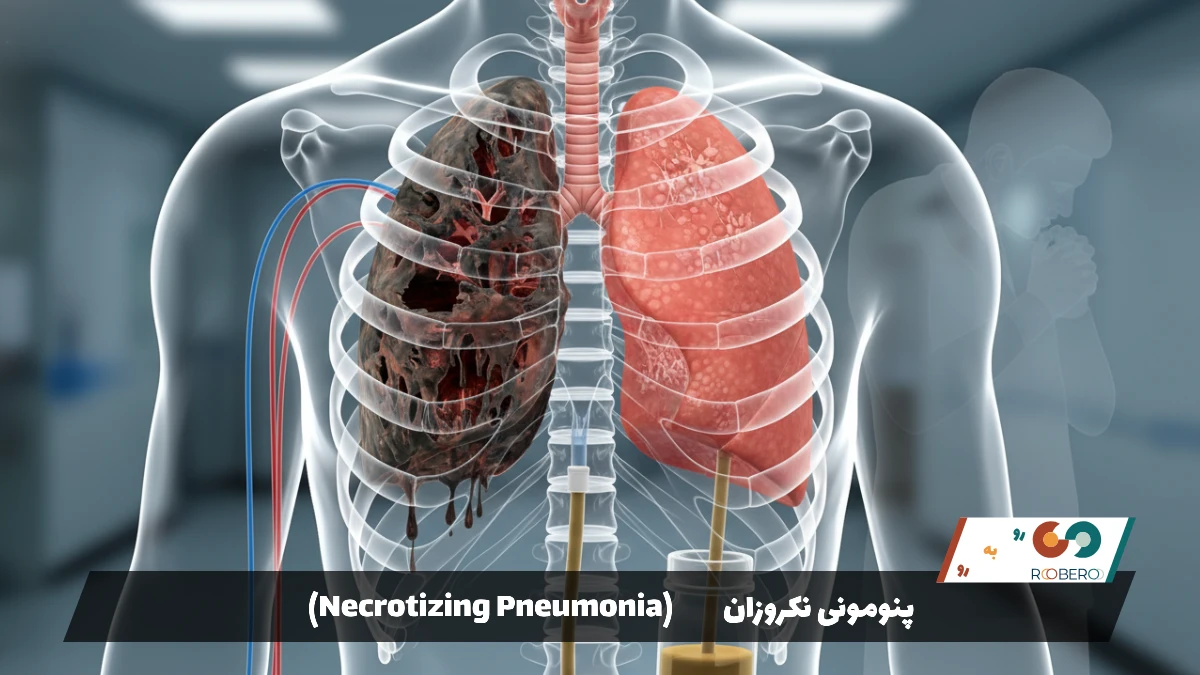 بیماری پنومونی نکروزان (Necrotizing Pneumonia)