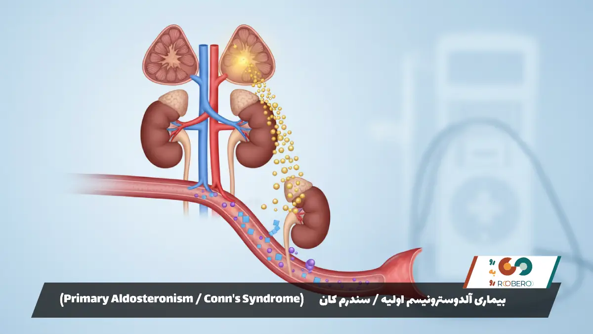 بیماری آلدوسترونیسم اولیه / سندرم کان (Primary Aldosteronism / Conn’s Syndrome)