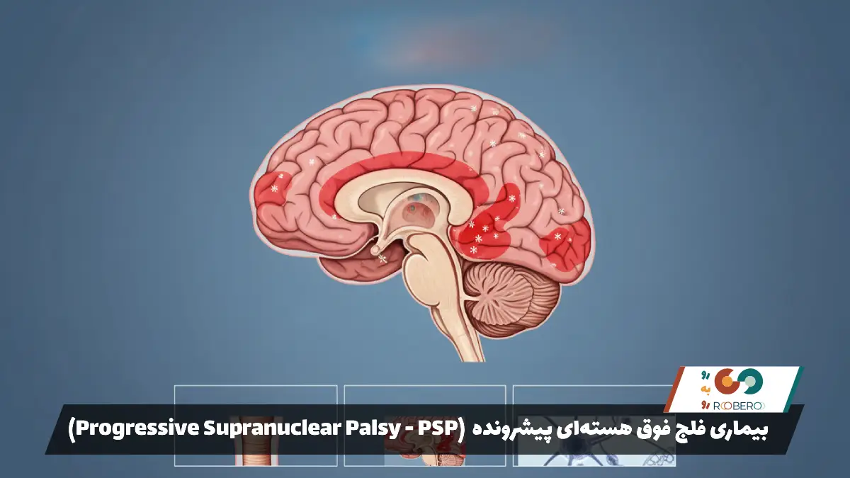 بیماری فلج فوق هسته‌ای پیشرونده (Progressive Supranuclear Palsy – PSP)