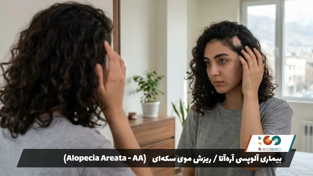 بیماری آلوپسی آره‌آتا / ریزش موی سکه‌ای (Alopecia Areata – AA)