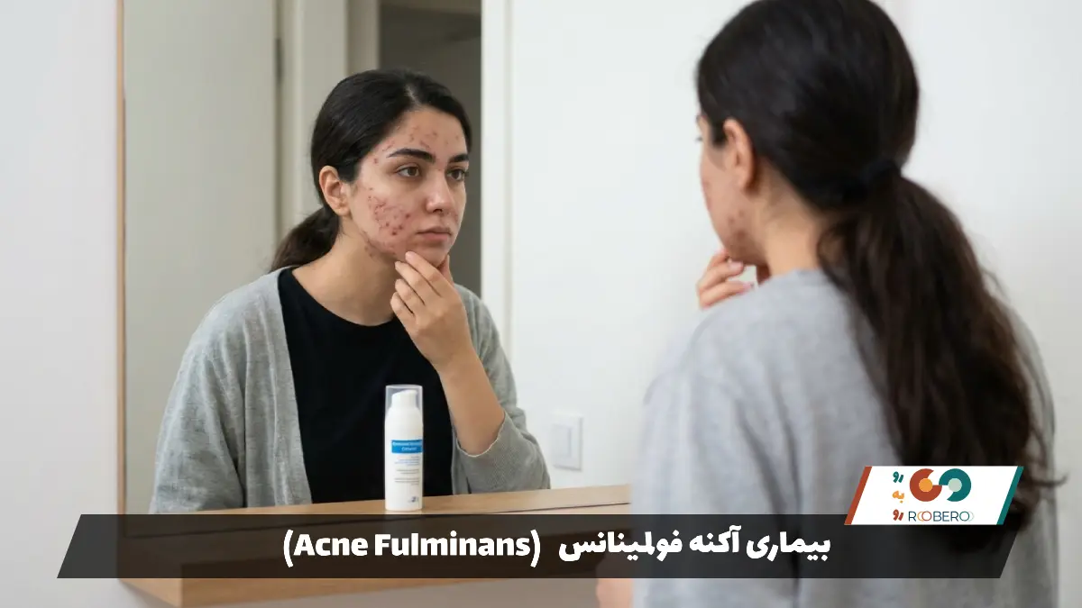 بیماری آکنه فولمینانس (Acne Fulminans)