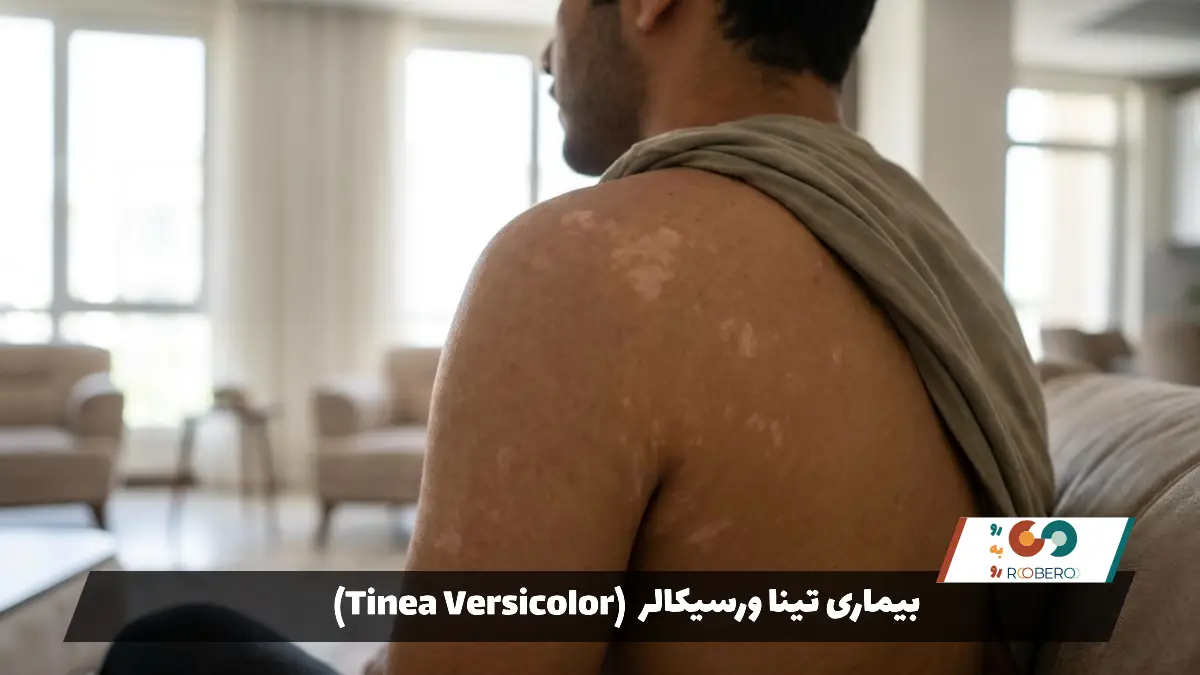 بیماری تینا ورسیکالر (Tinea Versicolor)