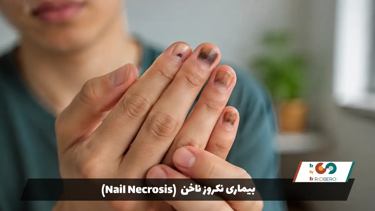 بیماری نکروز ناخن (Nail Necrosis)