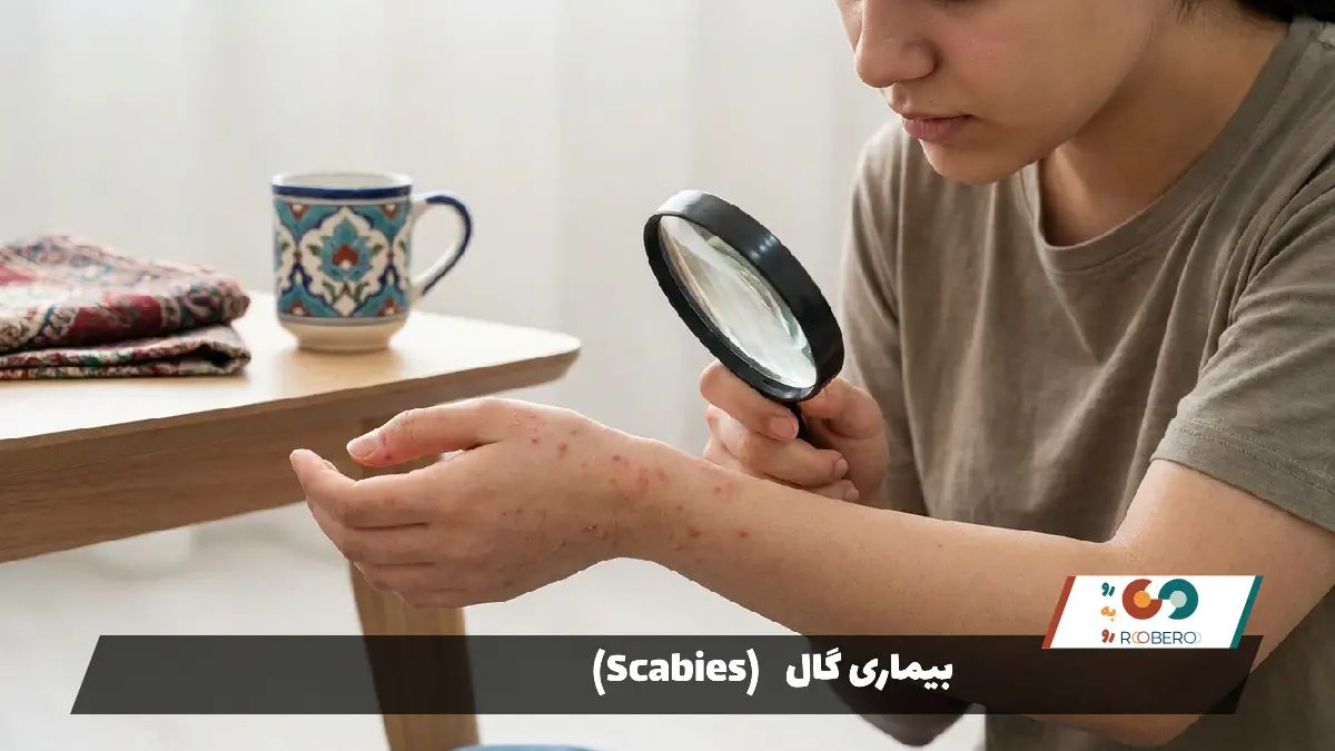 بیماری گال (Scabies)