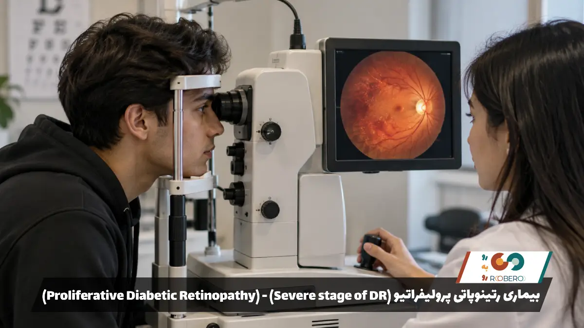 بیماری رتینوپاتی پرولیفراتیو (Proliferative Diabetic Retinopathy) – (Severe stage of DR)