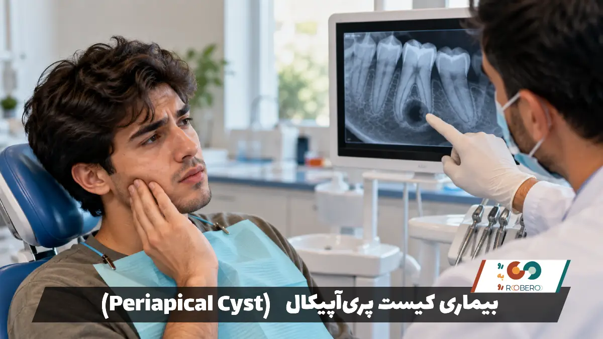 بیماری کیست پری‌آپیکال (Periapical Cyst)